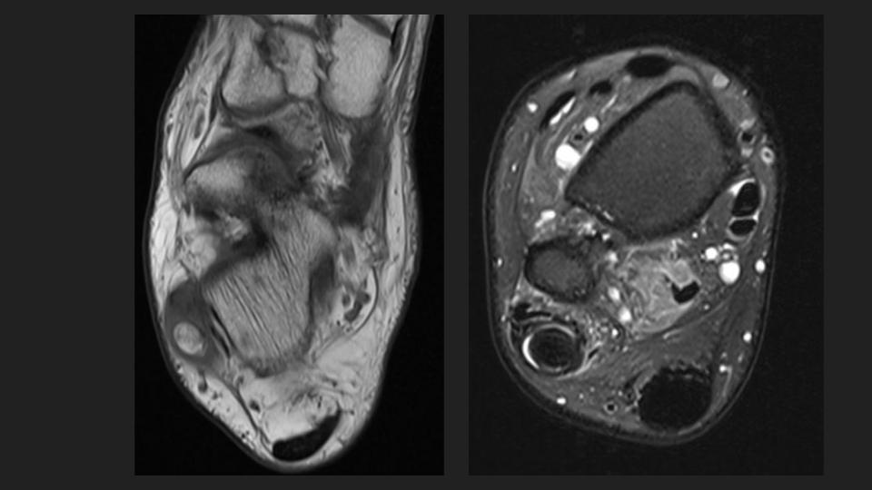 Figure 4 for case Charcot joint ( RID5075 )